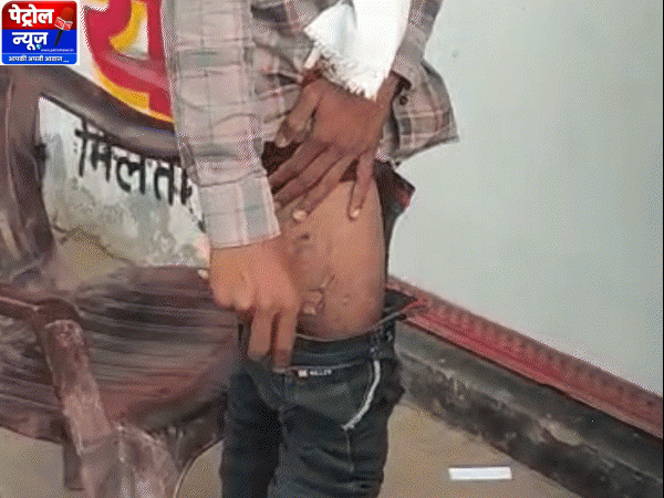रेडमी फोन राइडर्स पॉकेट में फट गया