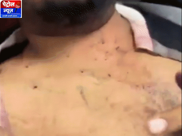 जबलपुर के इरशाद मंसूरी की आंख में चोट